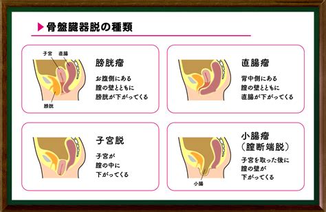 骨盤臓器脱